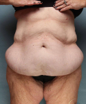 After Weight Loss Surgery Case 122 Before